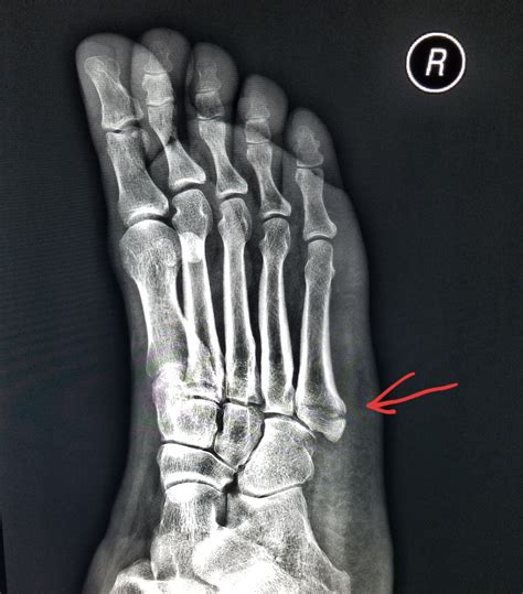 5th Metatarsal Break
