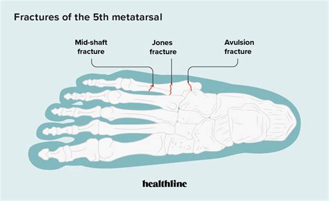 5th Metatarsal Break Prevention