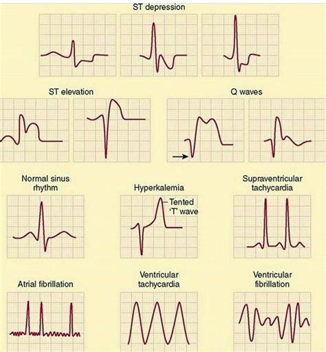 Arrhythmias