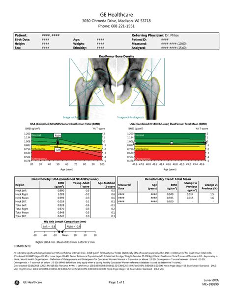 Bone Density Test Results