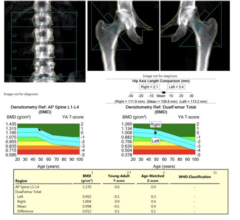 Bone Density Test Results Interpretation