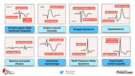 ECG Patterns