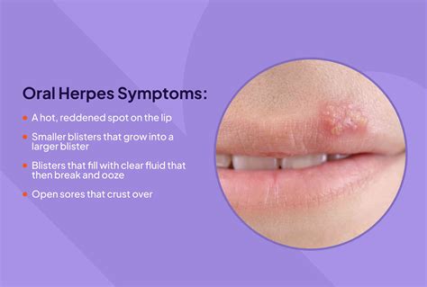 Herpes Symptoms
