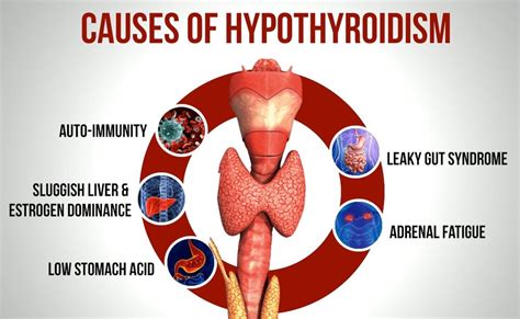 Hypothyroidism