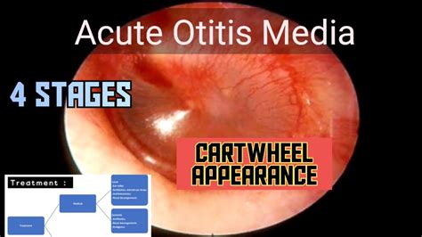 Otitis Media