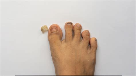 Treating Nail Loss