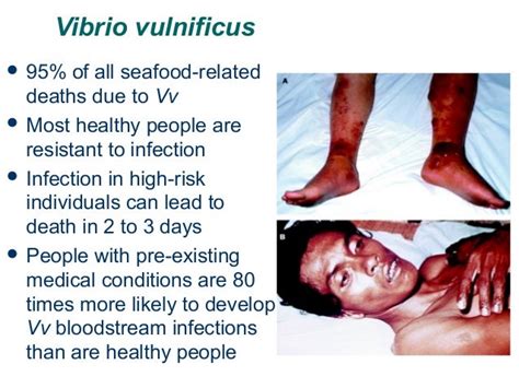Vibrio Vulnificus Outbreaks