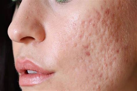 Acne Scars