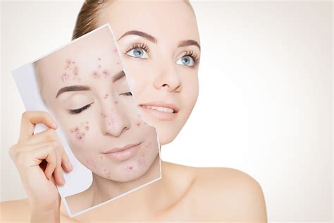 Acne Treatment