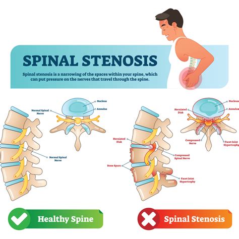 Acupuncture for Lumbar Spinal Canal Stenosis