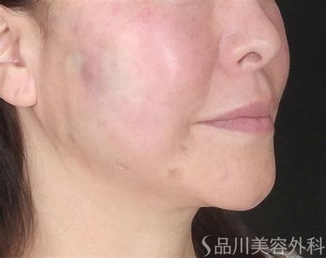 After Procedure