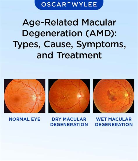 Age-Related Macular Degeneration