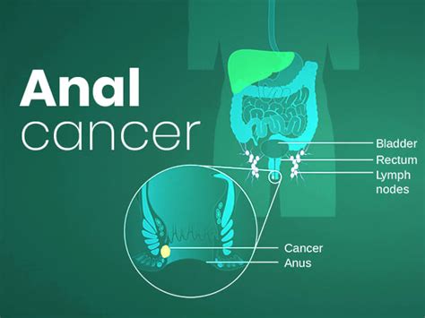 Anal Cancer