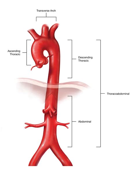 aneurysm aorta