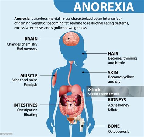 Anorexia Causes
