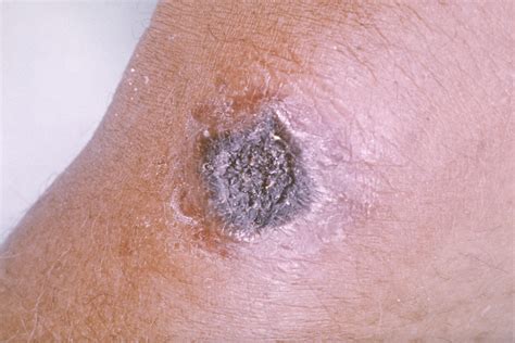 Anthrax Infection