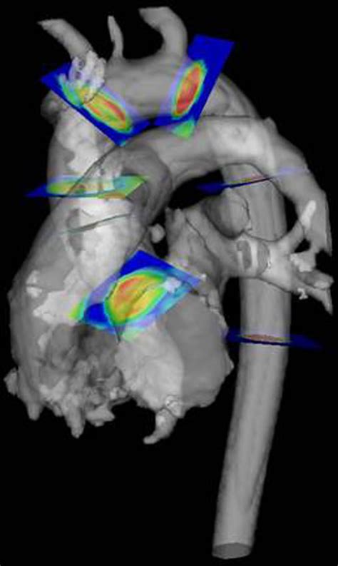 Aorta Conclusion