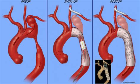 Aorta Treatment