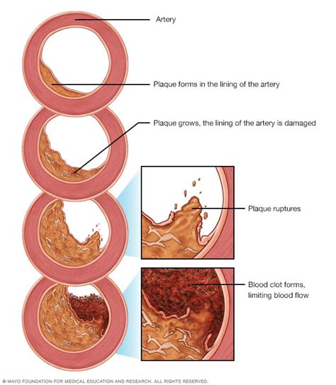 atherosclerosis aorta