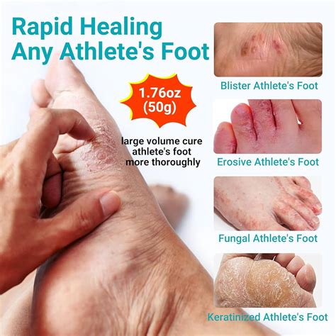 Athlete's Foot Treatment