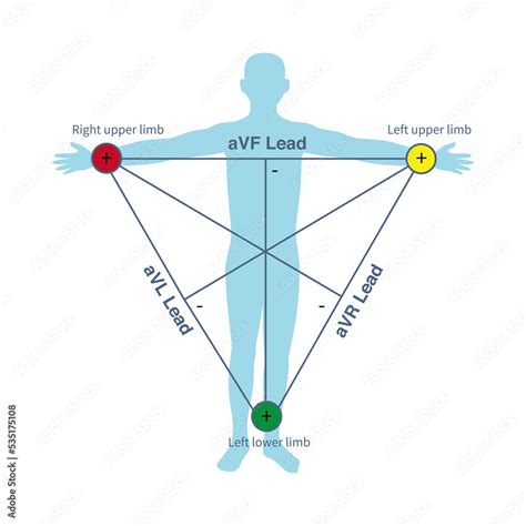 Augmented lead placement diagram