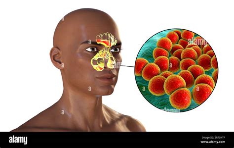 Bacterial Sinusitis