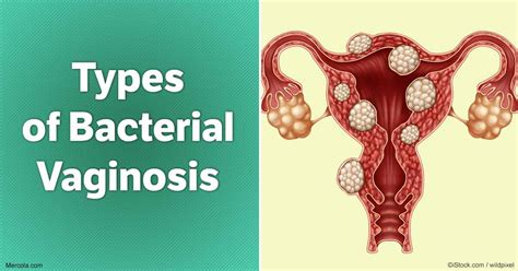 Bacterial vaginosis illustration