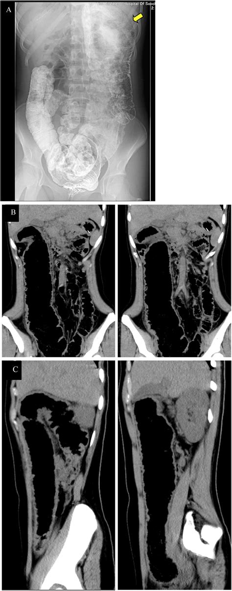 Barium CT scans