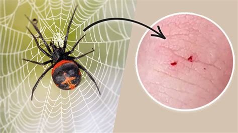 Black Widow Spider Bite Symptoms