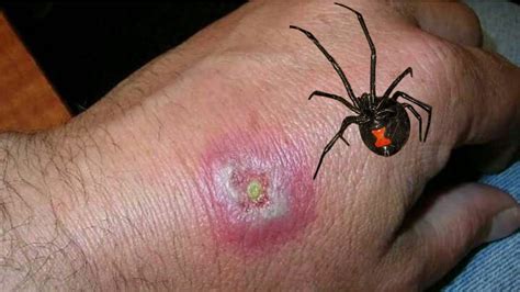 Black Widow Spider Bite Treatment