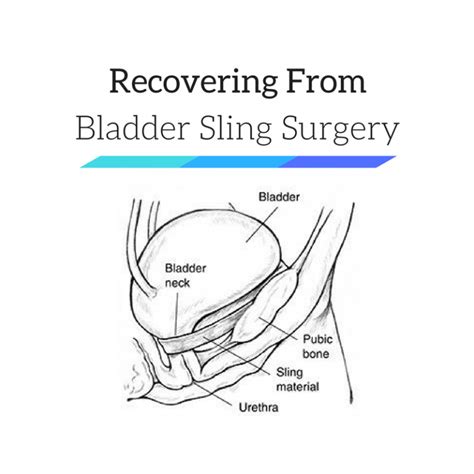 Bladder Sling Surgery
