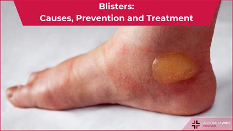 Blister causes