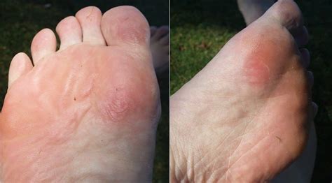 Blister healing