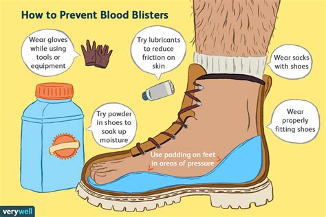 Blister prevention
