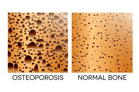 Enhanced bone density