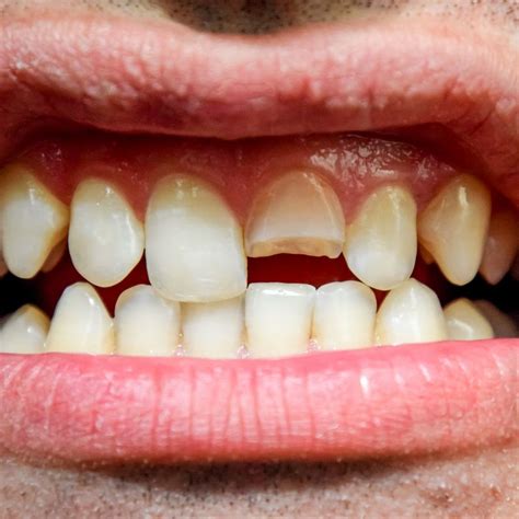 Broken Tooth