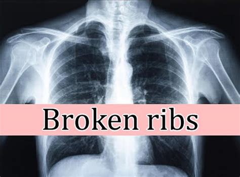 Bruised Ribs