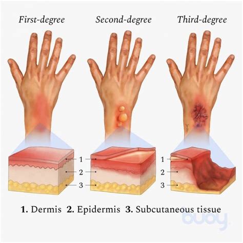 Burns Treatment