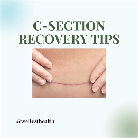 C-section recovery tips