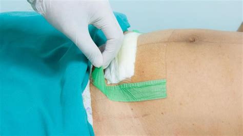 C-section wound healing