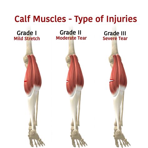 Calf Strain Image