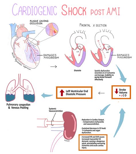 Cardiogenic shock