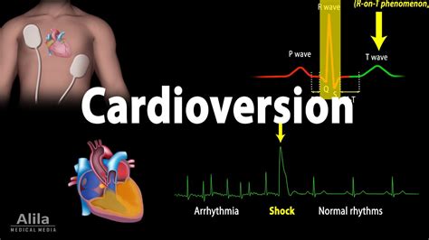 Cardioversion procedure