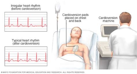 Cardioversion technique