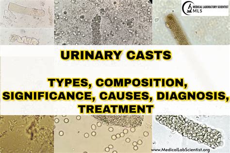 casts in urine