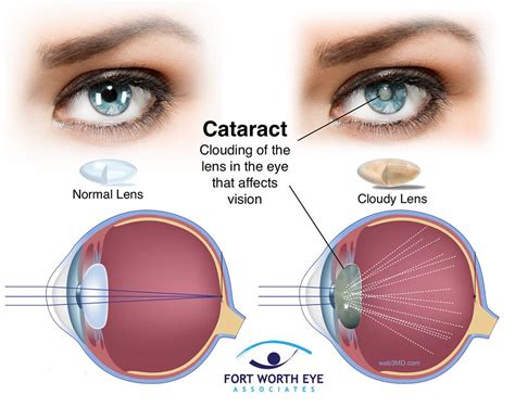 Cataract and LASIK Surgery