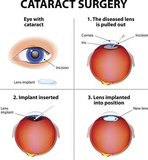 Cataract Surgery