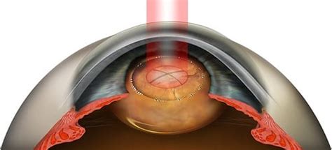 Cataract Surgery