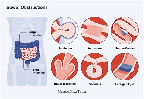 Causes of Bowel Obstruction