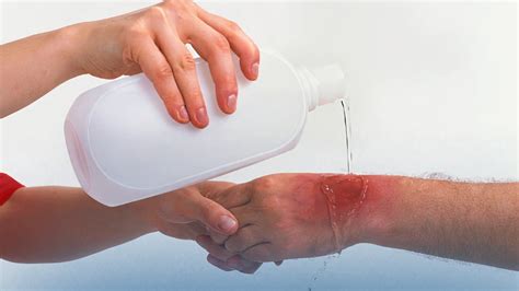 Chemical burn treatment